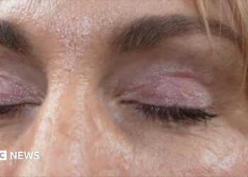 ‘My eyelids became infected – I was scared to sleep’